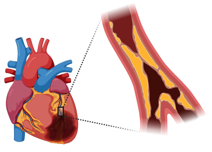 Cardiac ischaemia
